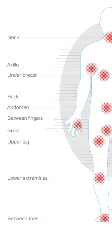 Intertrigo Symptoms, Intertrigo Rash Treatment