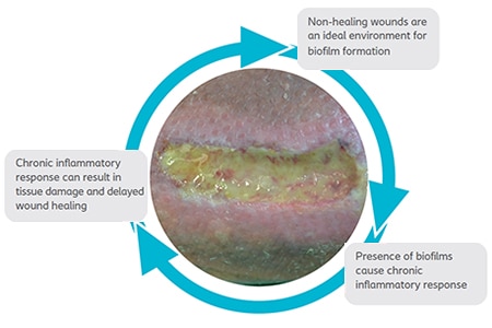 WSC-wound-infections-and-biofilm